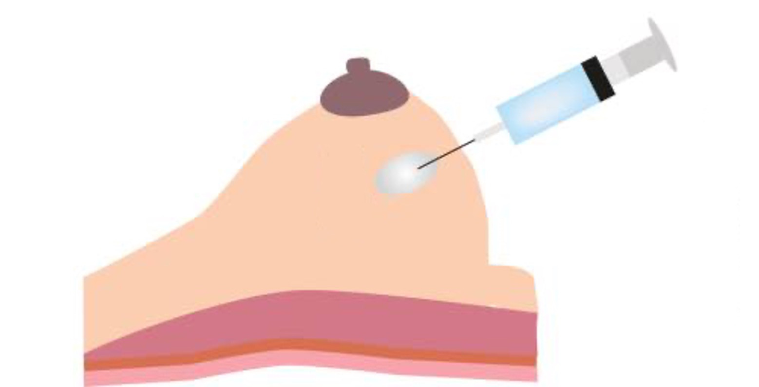 Gestioncomplications